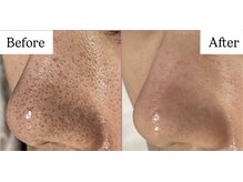 リノア(Lino'aka)の雰囲気(毛穴洗浄初・トルネード法でツルツル毛穴に♪)