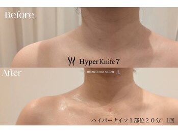 水玉サロン(水玉Salon)の写真/ハイパーナイフでデコルテ・肩を徹底ケア◎