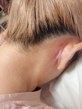 キアラ 麻布十番(Kiara)/うなじ脱毛