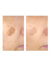 レイール(Reir)/フォト美顔　before→after