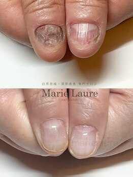 マリーロール 淀屋橋本店(Marie Laure)/自爪育成/深爪矯正/ネイルケア