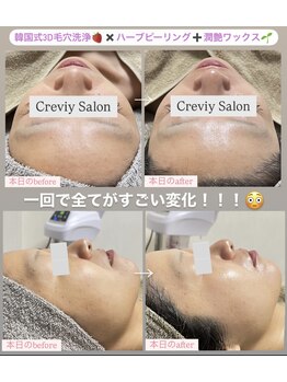 クレヴィー(Creviy)/3D毛穴洗浄×ハーブ×産毛脱毛