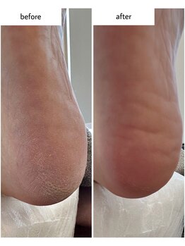 ケアプラス(care plus)/足裏角質ケア