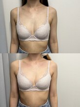 ジュリア(JULIA)/【バストアップ/育乳　症例】