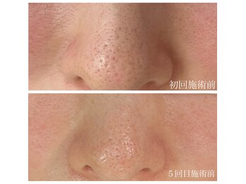 カピリナ(ka pilina)/初回と5回目の施術前写真で実感