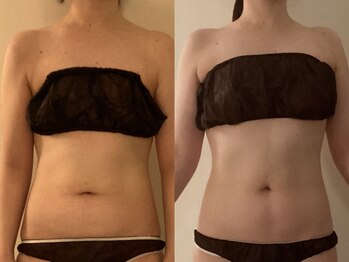 ミオン(美温)/腸もみ/むくみスッキリ