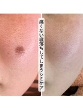 ココロ(COCORO)/シミケア