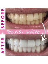 エクシアホワイトニング 渋谷駅西口店/ホワイトニングビフォーアフター