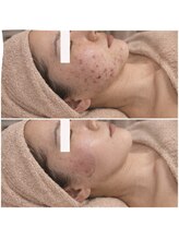 ルネル(Lunelle)/ニキビがないつるつるお肌に♪