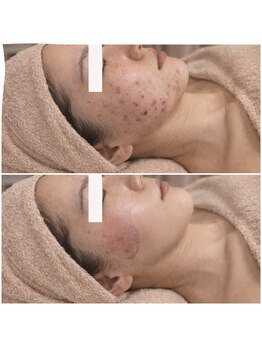 ルネル(Lunelle)/ニキビがないつるつるお肌に♪