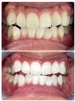 ココホワイトニング 天王寺店/ビフォーアフター8