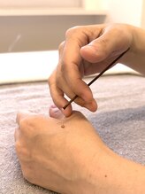 TJMととの鍼灸院/もぐさを捻ったお灸