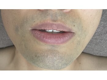 ナノハナ/鹿沼市全身脱毛美容室ナノハナ