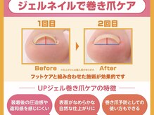 ベルフルーブ(Belle Fleuve)/特許取得巻き爪矯正アップジェル