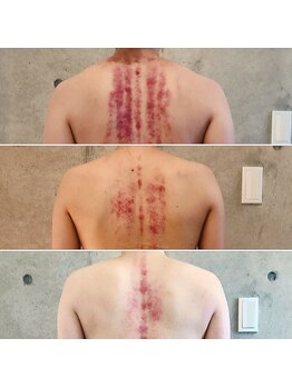 サプナジー(Suppnrgy)/かっさ使用