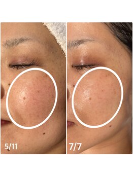 楚々(SOSO)/施術3回目