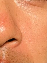 ピュアージュ/メンズもハーブピーリング！！