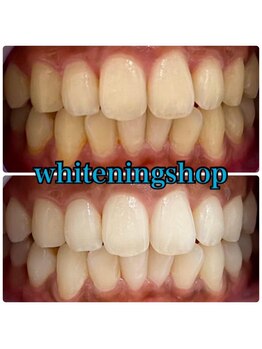 ホワイトニングショップ 山形店(Whiteningshop)/垢抜けは白い歯から