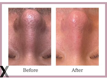 クロス(Xcross)/毛穴ケア【毛穴/代官山/渋谷】