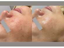 コア チャーム(CORE CHARM)/お肌のダークスポット