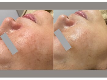 コア チャーム(CORE CHARM)/お肌のダークスポット