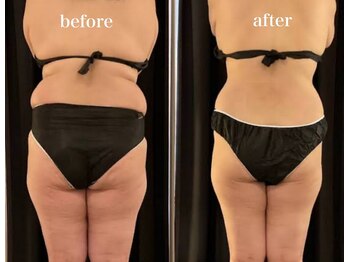 ラヴィブルー(raviblue)/脂肪冷却 全身可能