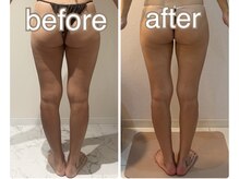 冷え固まった気になるセルライトに猛アプローチ！！