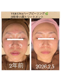 ココ 2号店(CoCo)/ハーブピーリング/VERUNA/たるみ