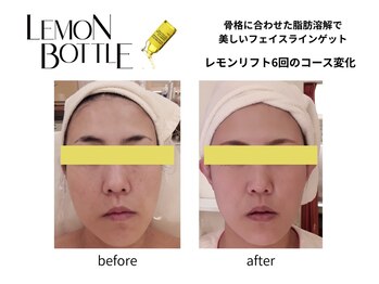 クリニカルエステ イーズ あべのキューズタウン店/FACEレモンボトル変化写真-1