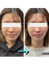 レベンディス(LEVENDIS)/マイクロカレント