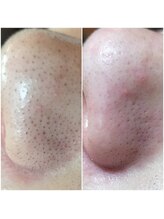 ゆるり/韓国式3D毛穴洗浄