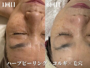 セレソル(CERESOL)/コルギ×ハーブピーリング×毛穴