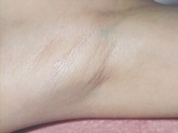 トータル ビューティ フィット/脱毛