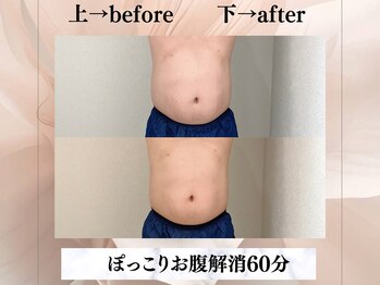 イヨヨ(iyoyo)/【痩身】Before After