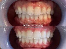 ココロビューティーギャラリー 武蔵小杉(cocorobeauty gallery)/2回セットオススメです★