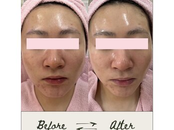 リアウェイク(Reawayke)/ララピール ビフォーアフター◎