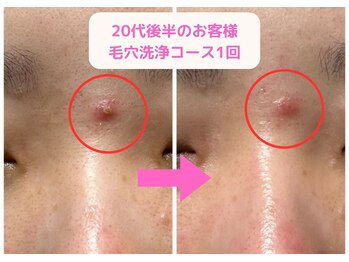 ヒーリング アンド ビューティー ナナ(Healing&Beauty nana)/たまご肌フェイシャルの症例