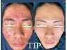 【本気ニキビケア】自然に剥けるTIPハーブピーリング イオン導入ヘッドスパ付