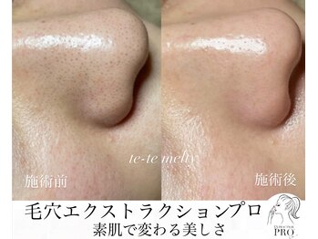 テテメルティ(te-te melty)