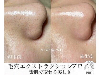 テテメルティ(te-te melty)の写真