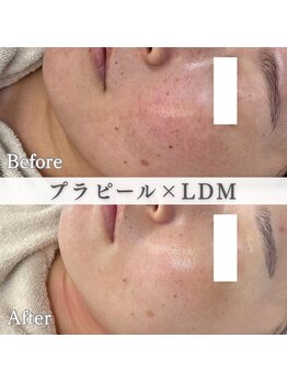 イロハ(IROHA)の写真/【韓国式美白肌管理】プラピール×LDM水玉リフティングでシミ・くすみに根本アプローチ!透明感あるツヤ肌へ
