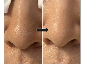 リーフ/ハイドロスプラッシュ★毛穴ケア