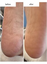 ケアプラス(care plus)/足裏角質ケア