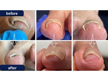 痛みのある巻き爪