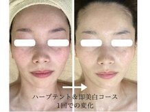 こもれび/１回のお手入れでの変化