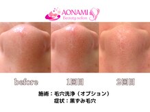 あおなみ はり きゅう整骨院/毛穴洗浄：黒ずみ毛穴、角栓