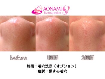 あおなみ はり きゅう整骨院/毛穴洗浄:黒ずみ毛穴、角栓