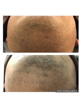 サロンシャイン(Salon Shine)/メンズヒゲ脱毛３０代後半男性