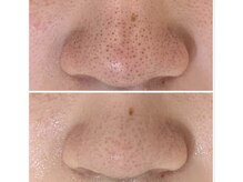 ザ フェース 難波店(THE FAITH)/毛穴悩みに