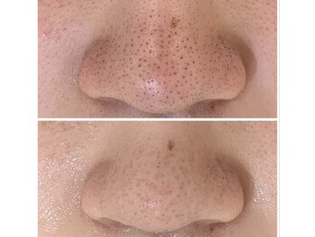 ザ フェース 難波店(THE FAITH)/毛穴悩みに